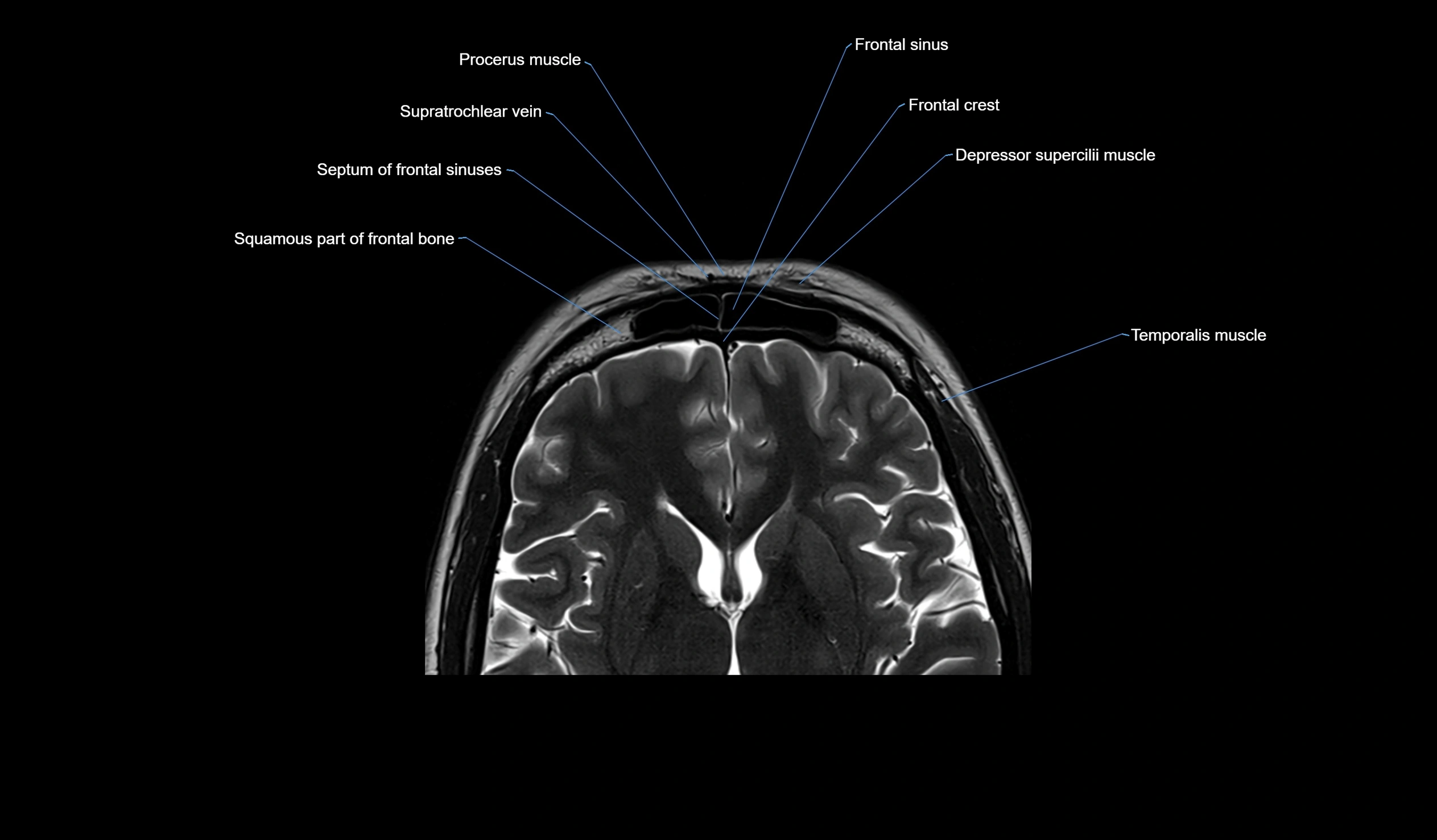 MRI face & paranasal sinuses(PNS) labelled  coronal  cross sectional anatomy 3T radiology  image-img-00001-00030.webp
